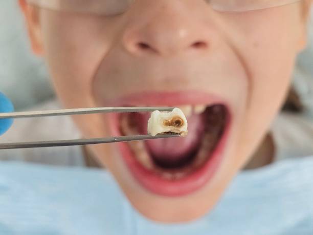 Best Urgent Tooth Repair  in Slayton, MN